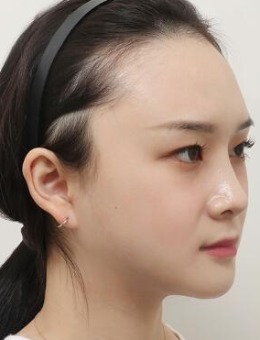 韩国note颧骨缩小+下颌角+双下巴吸脂恢复1个月照片