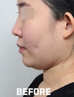 韩国爱她整形面部提升改善双眼皮手术案例_术前