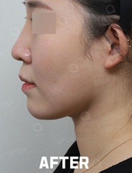 韩国爱她整形面部提升改善双眼皮手术案例_术后