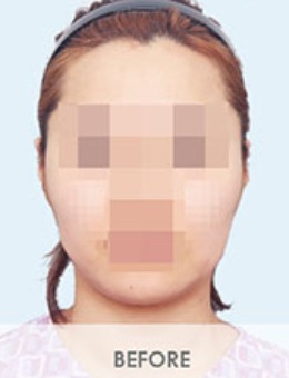 韩国BornDi整形颧骨下颌角+瘦脸针3组对比照分享_术前