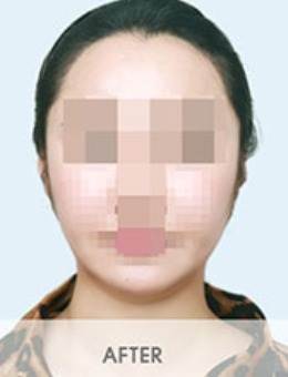 韩国BornDi整形颧骨下颌角+瘦脸3组对比照分享