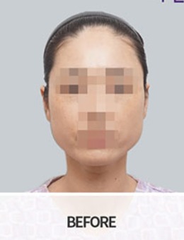 -韩国BornDi长曲线下颌角手术+肌肉去除手术对比照
