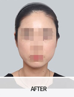 韩国BornDi长曲线下颌角手术+肌肉去除手术对比照
