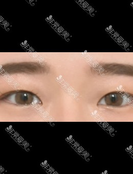 -韩国icon埋线双眼皮对比案例
