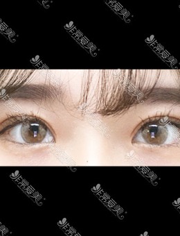 -韩国icon埋线双眼皮对比案例