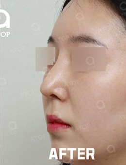 韩国爱她整形隆鼻手术对比照_术后