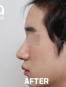 韩国爱她整形男士隆鼻手术案例