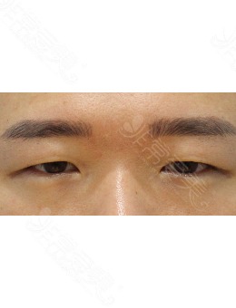 韩国zell眼提肌+额头提升手术对比照