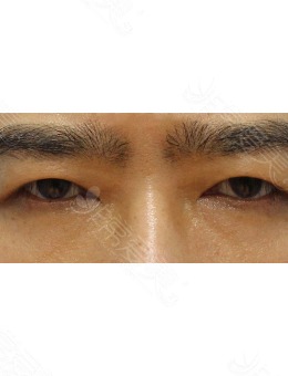 韩国zell整形男士眼提肌矫正对比照