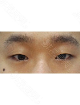 -韩国zell整形做眼睛提肌+开内眼角手术案例