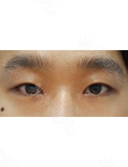 -韩国zell整形做眼睛提肌+开内眼角手术案例