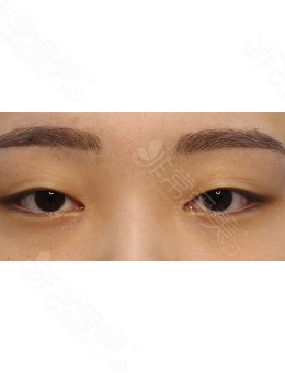 -韩国zell整形眼提肌手术对比案例