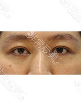 -韩国zell自然黏连双眼皮+眼提肌+眼底脂肪重置对比照片