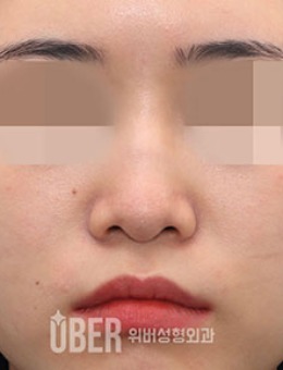 韩国玉芭Uber短鼻整形前后对比照片