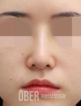 -韩国玉芭Uber短鼻整形前后对比照片
