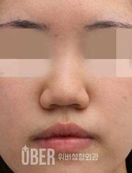 韩国玉芭整形女生蒜头鼻矫正隆鼻前后对比照