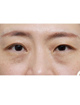 韩国爱她整形“大小眼”不对称手术对比照