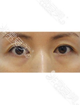 韩国zell整形双眼皮失败修复+眼提肌+去黑眼圈对比案例_术前
