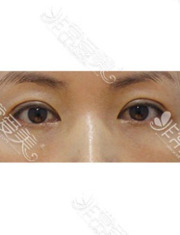 韩国zell整形双眼皮失败修复+眼提肌+去黑眼圈对比案例