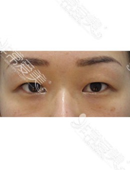 -韩国zell整形单眼皮眼综合施术对比照片