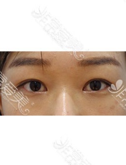 韩国zell整形单眼皮眼综合施术对比照片_术后