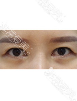 开眼角也能缝回去!韩国zell整形眼角修复+额头提升案例图