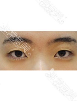 韩国zell整形双眼皮+提肌+后眼角+眼尾下至对比照片