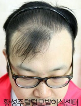 韩国喜剧明星拯救M秃发的植发日记_术前