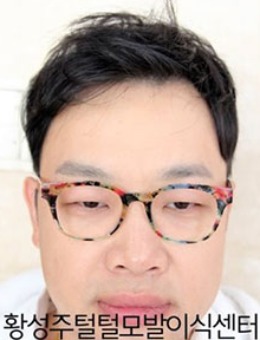 韩国喜剧明星拯救M秃发的植发日记_术后