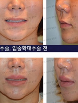 -韩国金薇整形微笑唇整形术后2年7个月照片分享