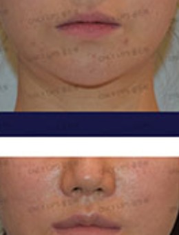 韩国金薇整形微笑唇+人中缩短手术1年对比照片