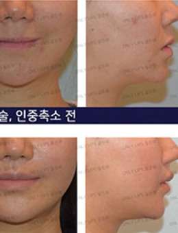 韩国金薇整形微笑唇+人中缩短手术1年对比照片_术后