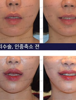 韩国金薇整形微笑唇+人中缩短术后2周对比照分享