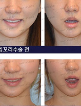 韩国金薇整形唇整形5个月对比照片