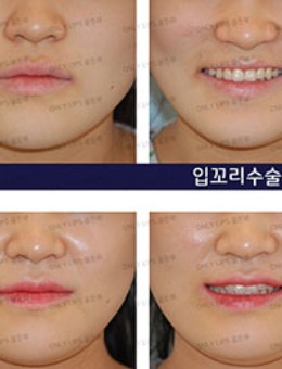 韩国金薇整形微笑唇手术对比照片