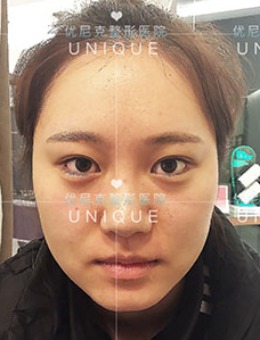 韩国优尼克整形眼鼻综合整形对比照片
