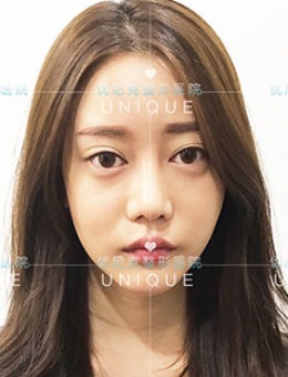 韩国优尼克整形双眼皮修复+面部轮廓手术对比照片_术前