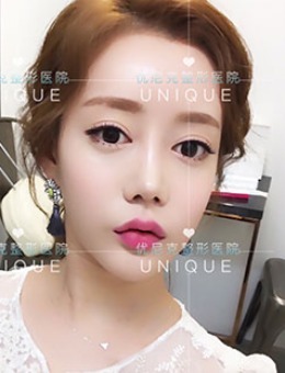 韩国优尼克整形双眼皮修复+面部轮廓手术对比照片