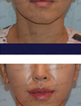 韩国金薇整形微笑唇手术对比案例
