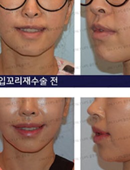 韩国金薇整形微笑唇手术对比案例