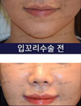 韩国金薇整形唇部整形手术对比照_术后