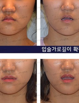韩国金薇整形嘴角下弯矫正手术对比照