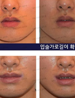 韩国金薇唇整形对比照片