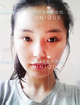 韩国优尼克整形双眼皮修复手术对比照片