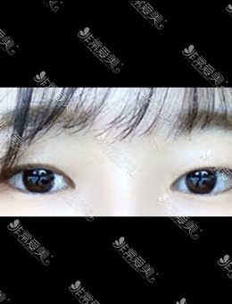 韩国icon非切开眼肌矫正手术对比照