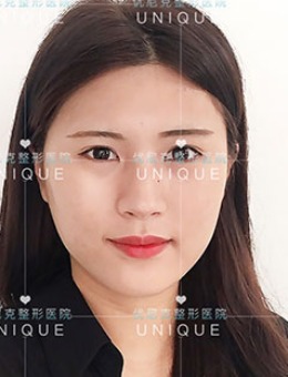 韩国优尼克眼睛+鼻子整形手术对比案例