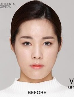 韩国齐娥整形轮廓三件套手术对比照片