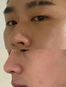 韩国dr朵整形男士鼻综合手术对比照_术前