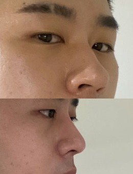 韩国dr朵整形男士鼻综合手术对比照_术后