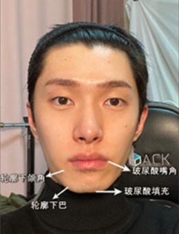 -韩国dr朵男士面部轮廓整形手术案例分享